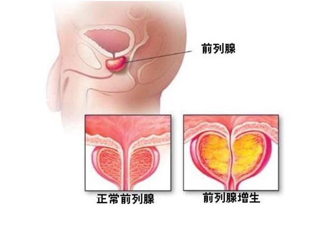 前列腺增生