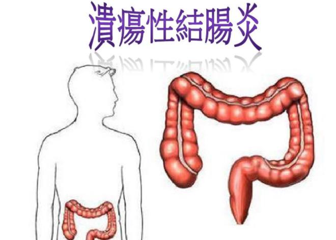 溃疡性结肠炎