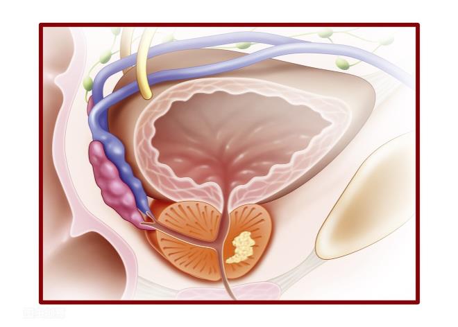 前列腺癌