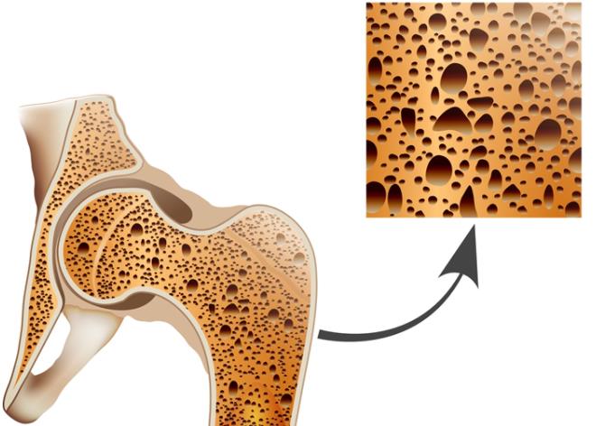 骨质疏松