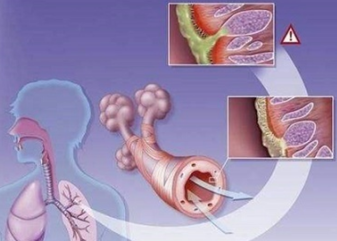 支气管炎
