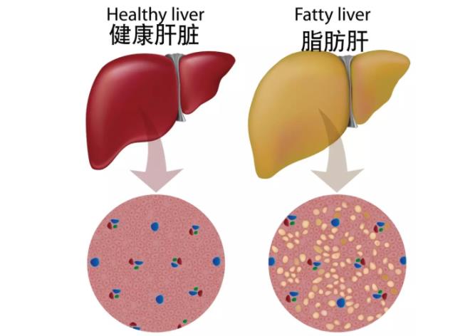 脂肪肝