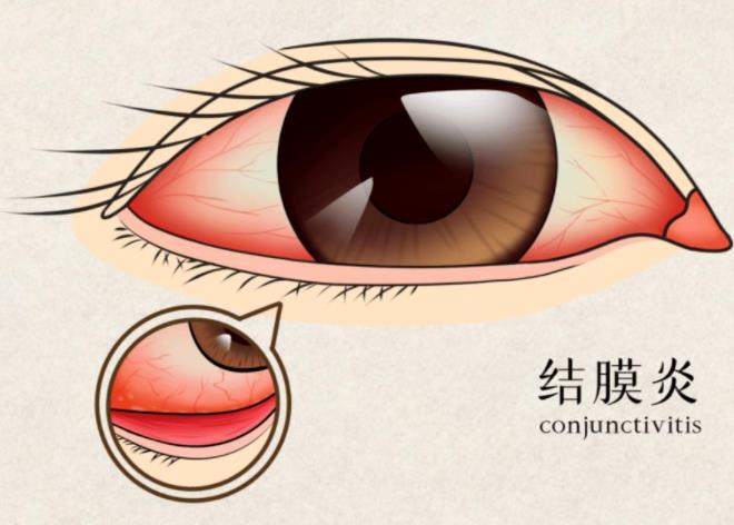 结膜炎和红眼病