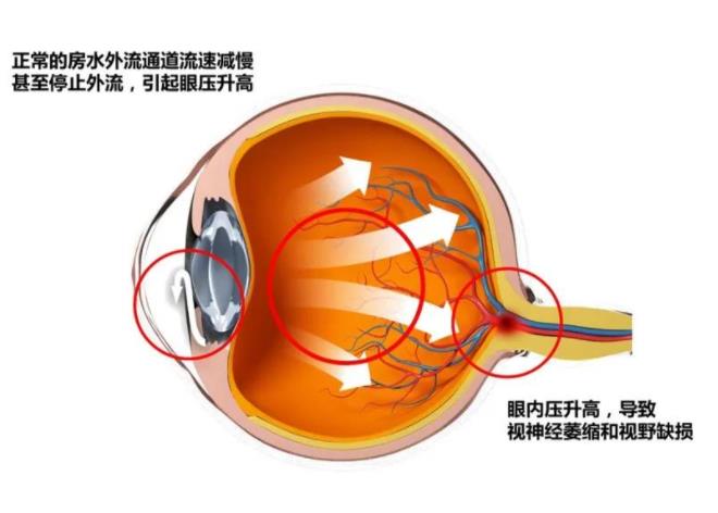 青光眼