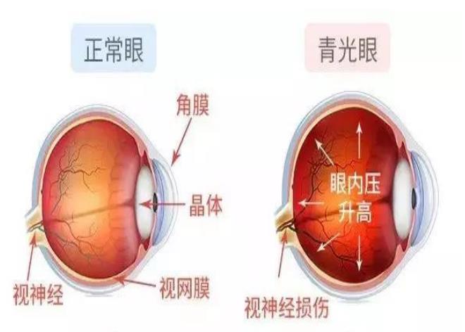 青光眼与正常眼睛图片图片