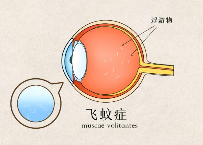 飞蚊症