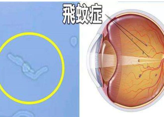 生理性飞蚊症和病理性飞蚊症