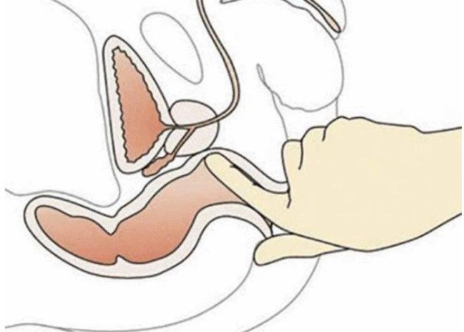 直肠指检