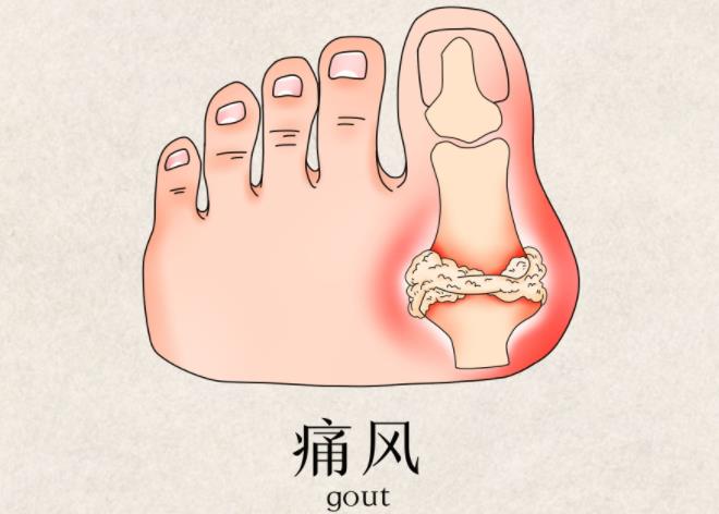 痛风合并其他疾病