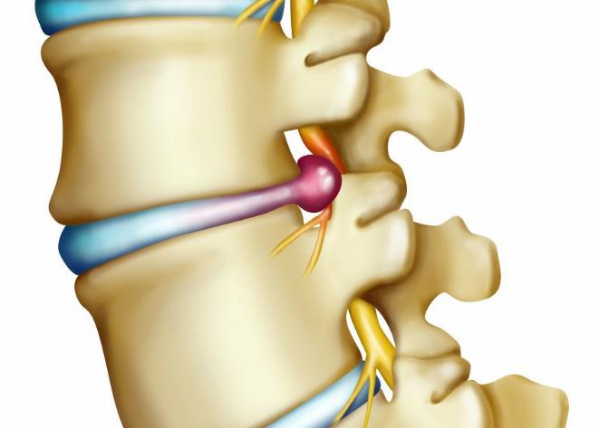 椎间盘突出