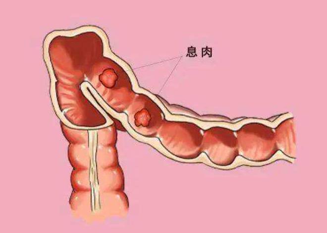 肠息肉