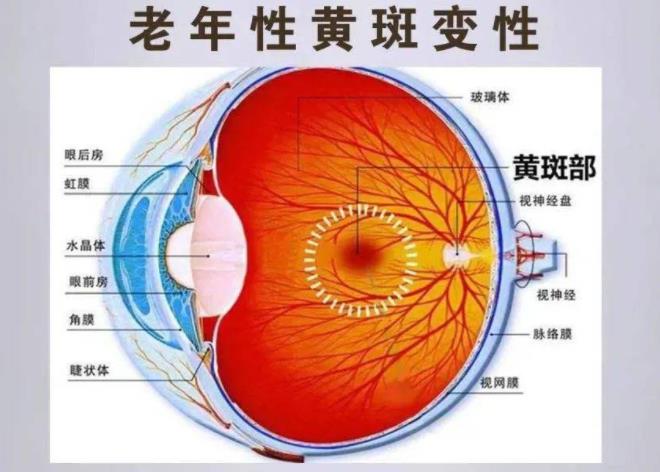 老年性黄斑变性