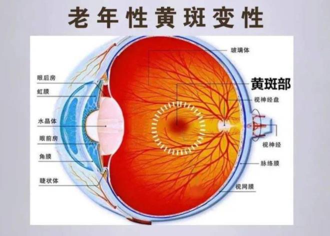 老年性黄斑变性