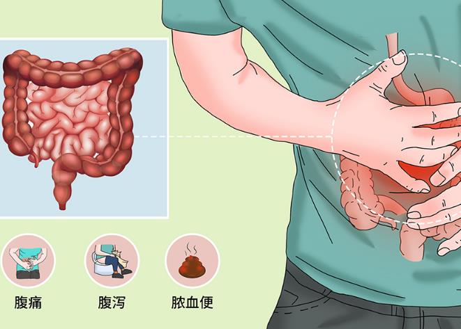 乙状结肠炎的症状图片