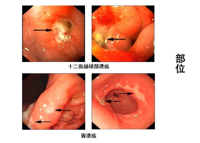 消化性溃疡