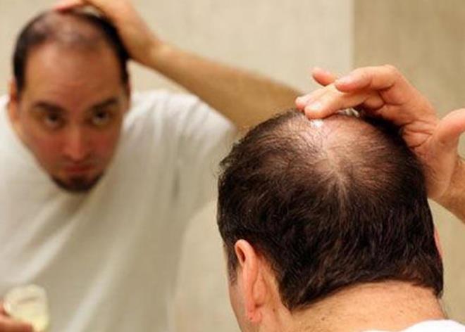 脱发,发际线后移,地中海发型…雄激素性脱发怎么治?
