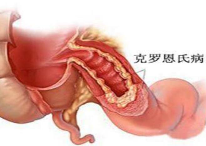 克罗恩病