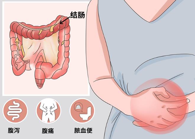 溃疡性结肠炎