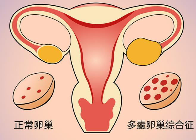 多囊卵巢综合症