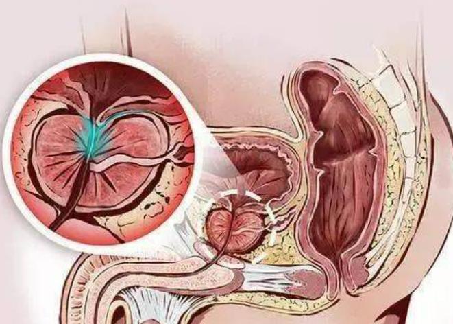  前列腺增生