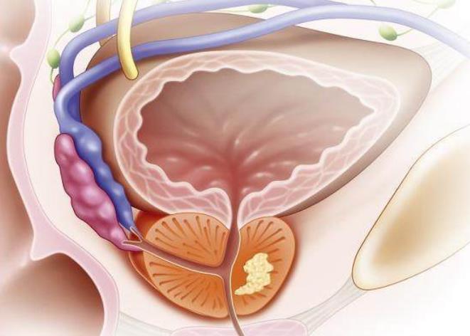 前列腺癌