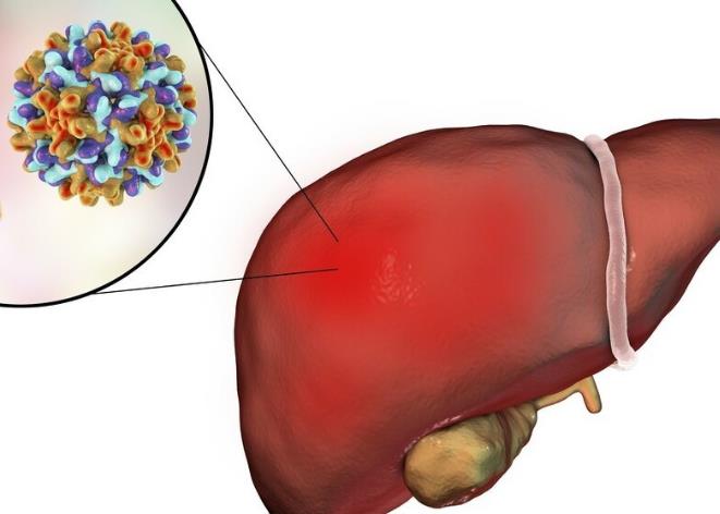 乙型肝炎