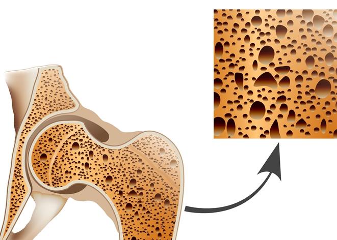 骨质疏松症