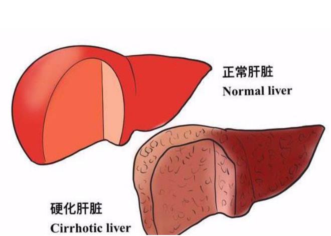 肝硬化