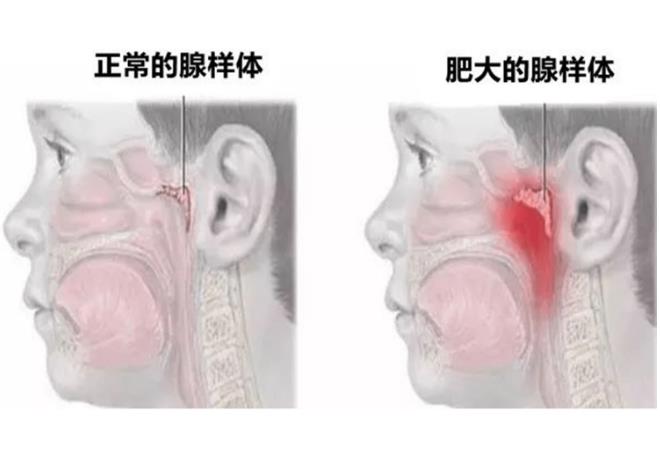 腺样体肥大