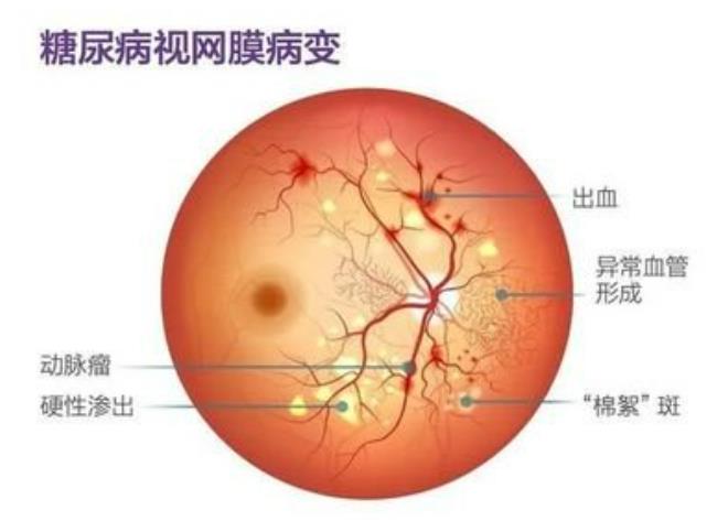 糖尿病视网膜病变