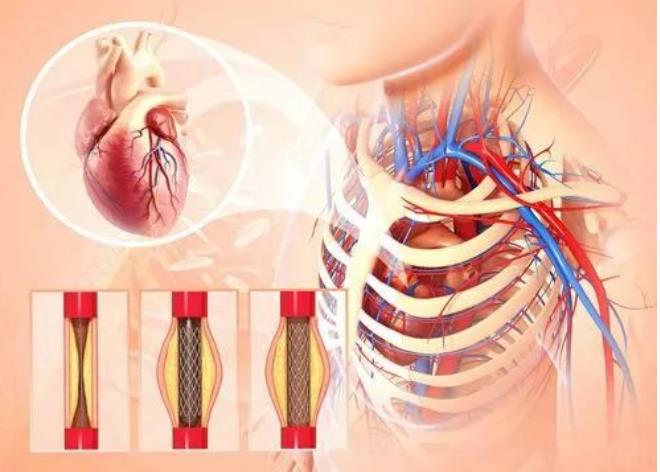 心脏支架