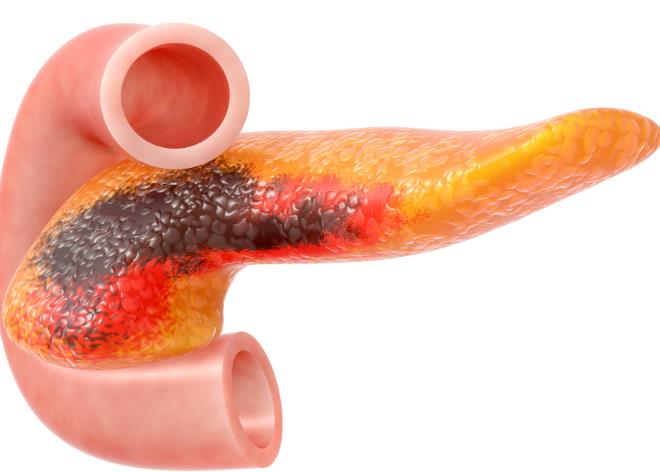 胰腺炎