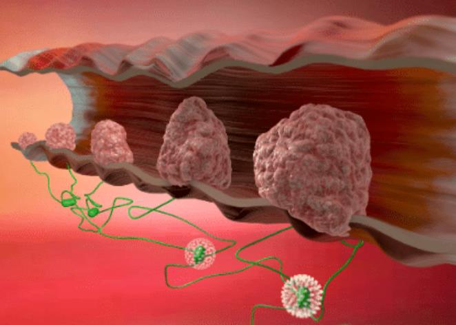 结直肠癌