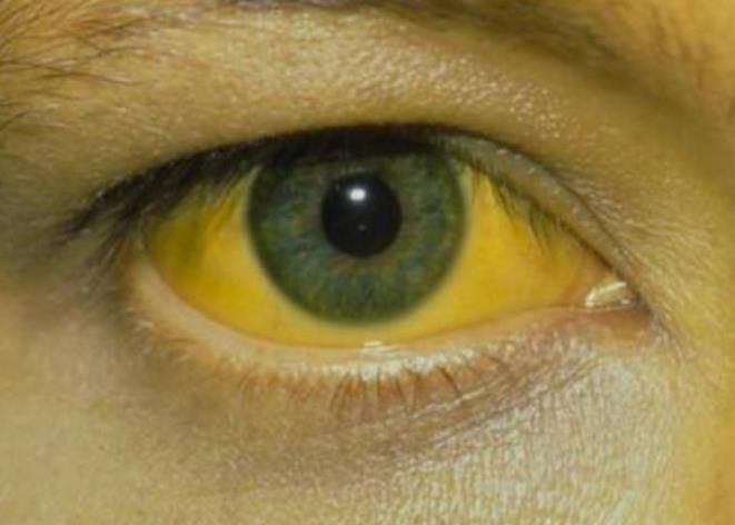 眼睛怎么黄才算是黄疸图片