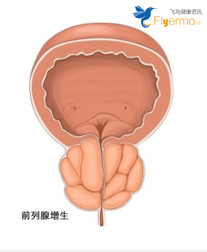 前列腺增生需要的注意事项！