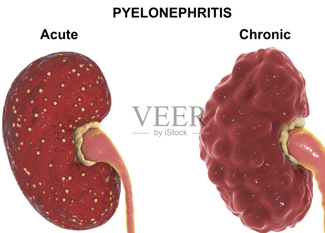 通常女性比男性跟容易得肾盂肾炎如何治疗呢？
