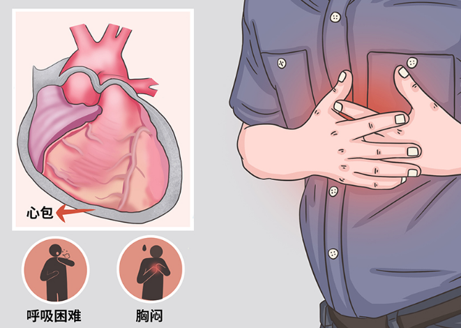 胸痛左肩膀痛很可能是出现心包炎？是什么原因导致心包炎？
