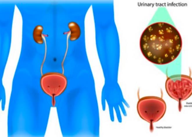 为什么会出现复发性尿路感染？肾虚尿路感染反复发作，真的无法控制？