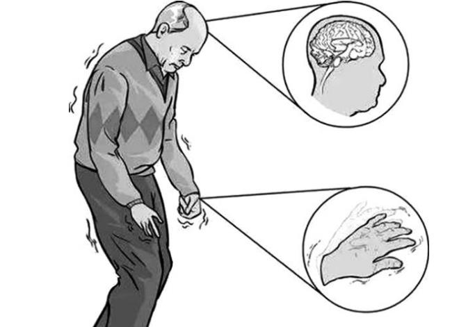帕金森怎么治疗最有效？你知道跳舞也可以治疗帕金森了吗！