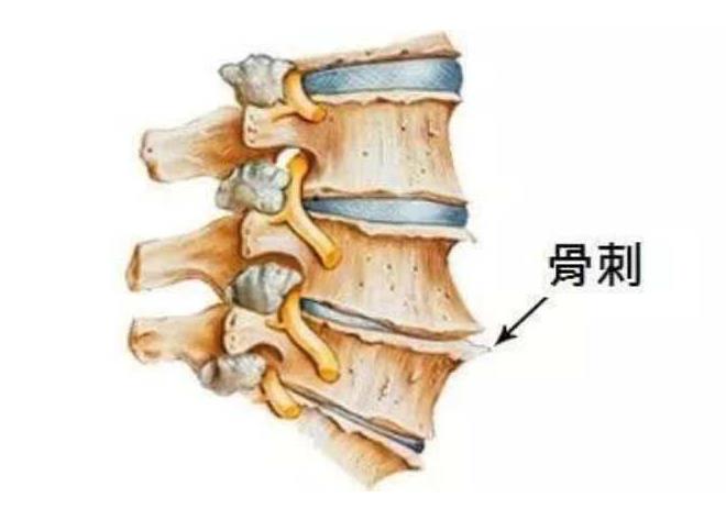 骨刺就是骨头里长刺了吗，骨质增生到底要不要治疗？