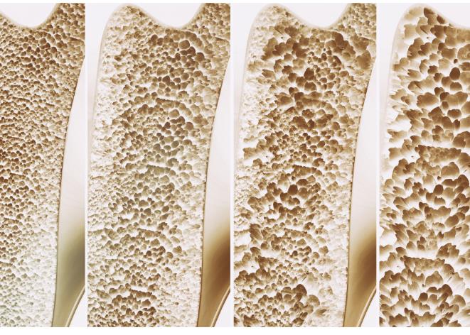 骨质疏松可不是小事！树立骨骼健康意识，学会预防骨质疏松很重要