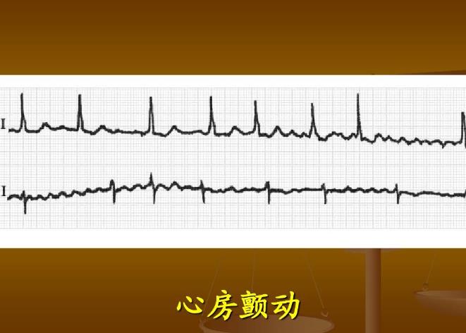 治疗心房颤动有两种方法，恢复正常心律是第一步，用什么药？