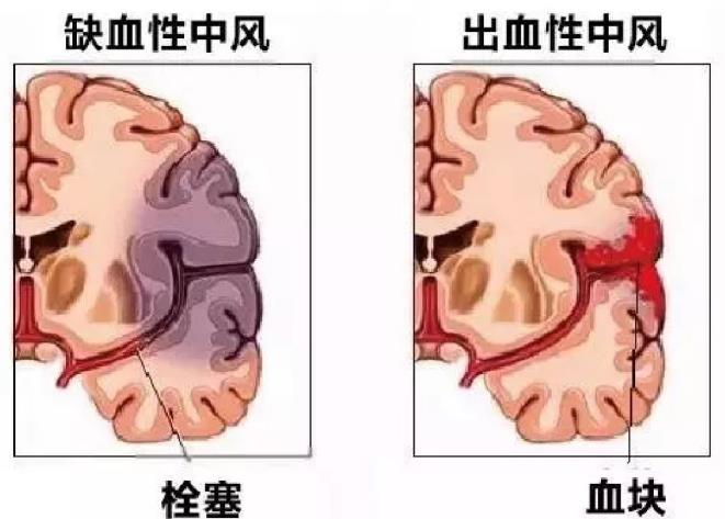 中风是如何盯上老年人的，急性中风应该如何进行诊断治疗？