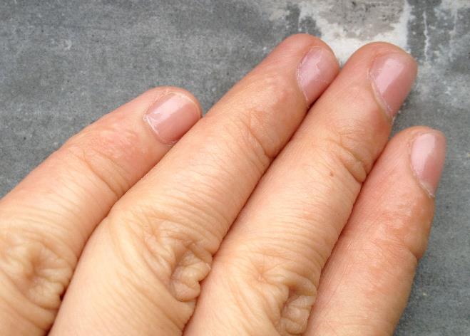 糖尿病患者为什么会出现手指硬化症？1型还是2型糖尿病更容易患？