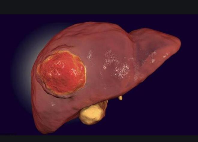 肝癌的人都患有肝硬化，肝硬化是癌症吗？被诊断出肝硬化就是晚期吗？