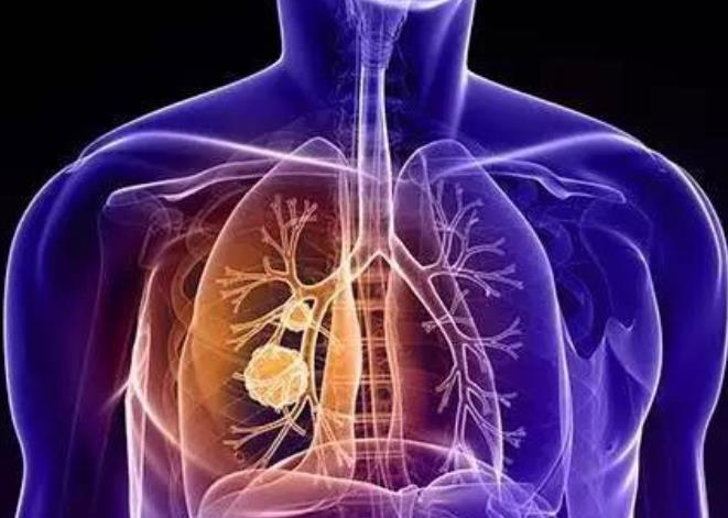 肺部出现癌变之后，是如何产生变化的？这些分期以及类型你了解吗