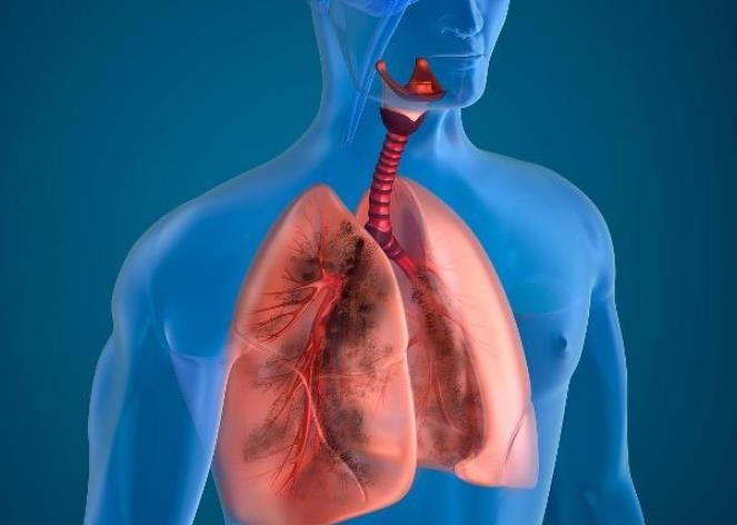 肺栓塞只影响肺部情况？多种检查可诊断或排除肺栓塞