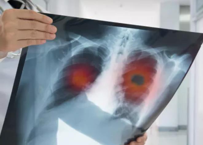肺部的"隐形杀手"--肺气肿，有什么药物能缓解症状？
