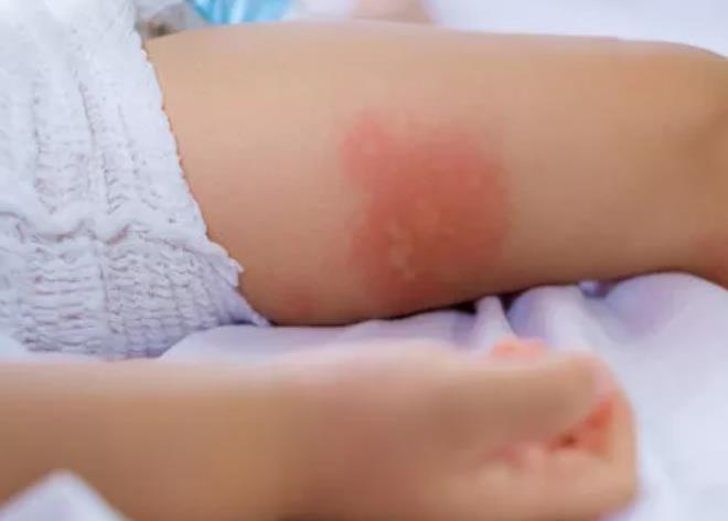 瘙痒、皮肤干燥，反复湿疹很苦恼？湿疹会传染吗？