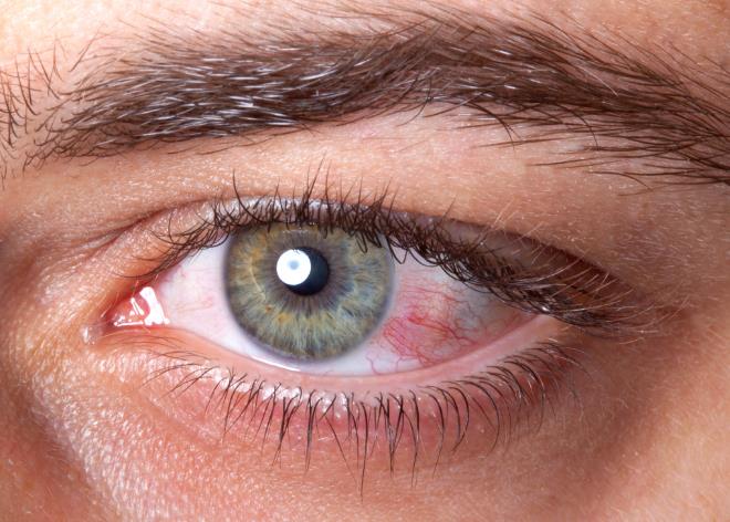 为什么会出现眼睛红血丝？4种情况，让你眼睛“红”